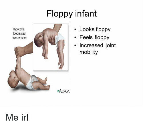 floppy-infant-hypotonia-decreased-muscle-tone-looks-floppy-feels-31050599.png